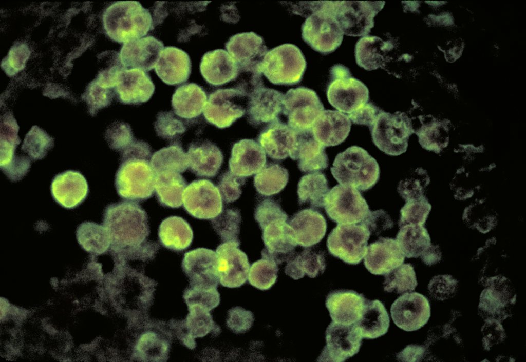 Healthcare Fraud And Consumer Protection: Barry Cadden Sentenced for Racketeering Leading to Nationwide Fungal Meningitis Outbreak 1 Consumer Protection